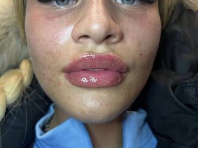 Russian Lips Transformation by Expert Practitioner Ben: Enhance Your Beauty Today!